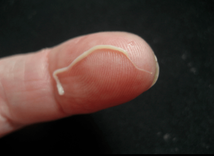 ümarusside parasiit inimkehast